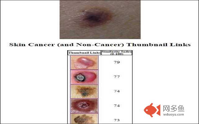 Skin Cancer Image Search